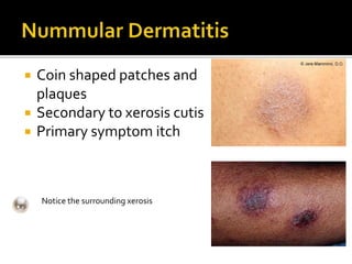 Coin Rash Dermatitis | PPTX