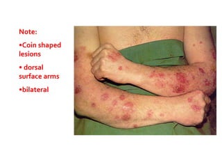 Three Coin Rashes Dermatitis | PPTX