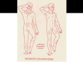 Peripheral Excoriating Rash Dermatitis | PPTX