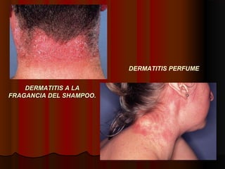 DERMATITIS A LADERMATITIS A LA
FRAGANCIA DEL SHAMPOO.FRAGANCIA DEL SHAMPOO.
DERMATITIS PERFUME
 