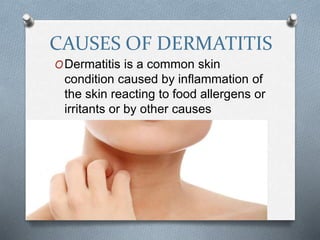 CAUSES OF DERMATITIS
ODermatitis is a common skin
condition caused by inflammation of
the skin reacting to food allergens or
irritants or by other causes
 