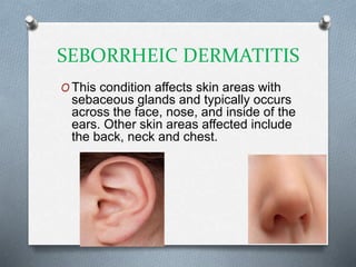 SEBORRHEIC DERMATITIS
O This condition affects skin areas with
sebaceous glands and typically occurs
across the face, nose, and inside of the
ears. Other skin areas affected include
the back, neck and chest.
 