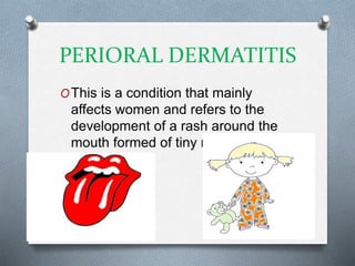 PERIORAL DERMATITIS
OThis is a condition that mainly
affects women and refers to the
development of a rash around the
mouth formed of tiny raised, red
bumps
 