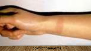 CONTACT DERMATITIS
 