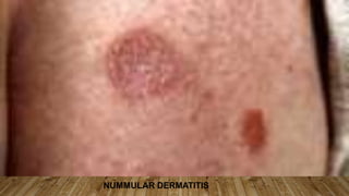 NUMMULAR DERMATITIS
 