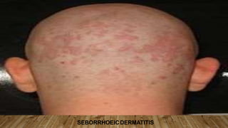 SEBORRHOEICDERMATITIS
 