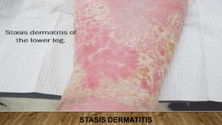 STASIS DERMATITIS
 