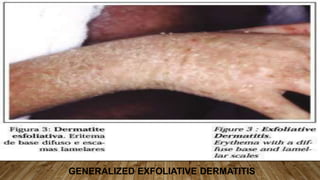 GENERALIZED EXFOLIATIVE DERMATITIS
 