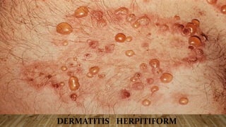 DERMATITIS HERPITIFORM
 