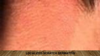 LOCALIZED SCRATCH DERMATITIS
 