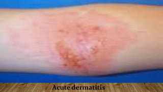 Acute dermatitis
 