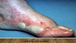 CHRONIC DERMATITIS
 