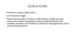 GEJALA KLINIS
• Penderita mengeluh gatal sekali.
• Lesi biasanya tunggal
• Berawal berupa plak erimatosa, sedikit edema, lambat laun jadi
edema dan eritema menghilang, bagian tengah berskuama dan
menebal, likenifikasi dan ekskoriasi, sekitarnya hiperpigmentasi, batas
kulit normal tidak jelas
 