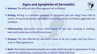 Dermatitis Treatment | PDF