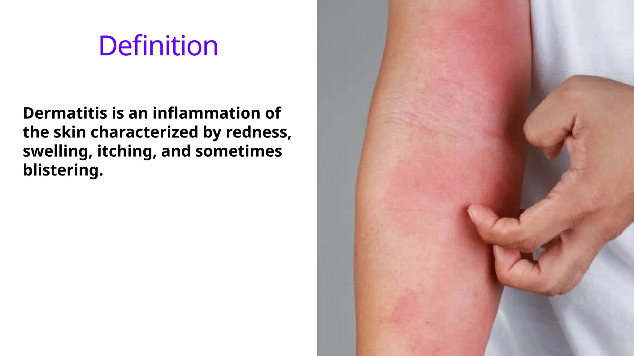 Dermatitis Problem Dermatitis -' Inflammation of the Skin ' | PPT