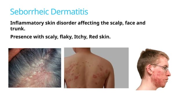 Dermatitis -' Inflammation of the Skin ' | PPT
