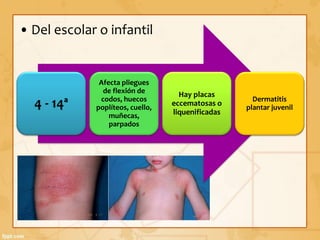 Dermatitis atópica | PDF