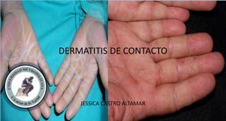 DERMATITIS DE CONTACTO
JESSICA CASTRO ALTAMAR
 