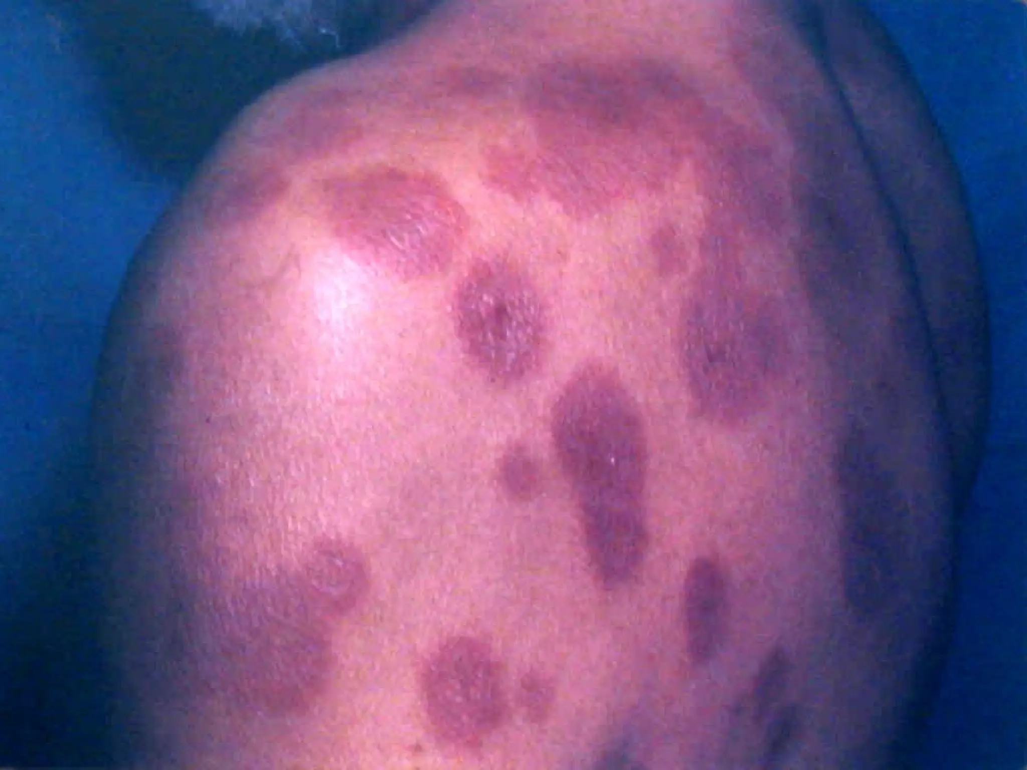 Dermatitis Por Medicamentos (Farmacodermias )1 | PPT