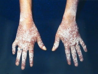 Dermatitis Por Medicamentos (Farmacodermias )1 | PPT