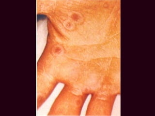 Dermatitis Por Medicamentos (Farmacodermias )1 | PPT