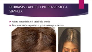 PITIRIASIS CAPITIS O PITIRIASIS SICCA
SIMPLEX
 Afecta parte de la piel cabelluda o toda
 Descamación blanquecina o grisácea con prurito leve
 