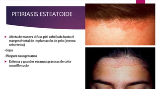 PITIRIASIS ESTEATOIDE
 Afecta de manera difusa piel cabelluda hasta el
margen frontal de implantación de pelo (corona
seborreica)
-Cejas
-Pliegues nasogenianos
 Eritema y grandes escamas grasosas de color
amarillo sucio combinadas con costras y
exudado
 
