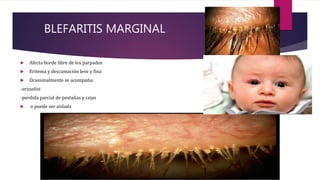 BLEFARITIS MARGINAL
 Afecta borde libre de los parpados
 Eritema y descamación leve y fina
 Ocasionalmente se acompaña:
-orzuelos
-perdida parcial de pestañas y cejas
 o puede ser aislada
 