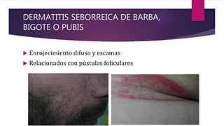 DERMATITIS SEBORREICA DE BARBA,
BIGOTE O PUBIS
 Enrojecimiento difuso y escamas
 Relacionados con pústulas foliculares
 