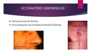 ECCEMATIDES SEBORREICAS
 Varones de mas de 20 años
 Se ha propuesto una variedad acentuación folicular
 
