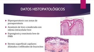 DATOS HISTOPATOLÓGICOS
 Hiperqueratosis con zonas de
paraqueratosis
 Acantosis de leve a moderada con
edema intracelular leve
 Espongiosis y exocitosis leve de
PMN
 Dermis superficial: capilares
dilatados e infiltrados de leucocitos
 