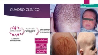 CUADRO CLINICO
COSTRA DE LECHE:
3 primeros
meses de vida
Hiperplasia de las
glándulas sebáceas
en el dorso de la
nariz
Placas escamosas y
oleosas de tamaño y
forma variables en :
-piel cabelluda
-región
centro facial
-parte media
del pecho
 