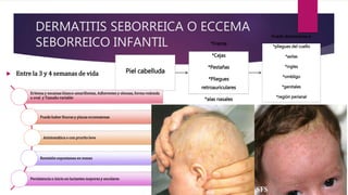 DERMATITIS SEBORREICA O ECCEMA
SEBORREICO INFANTIL
 Entre la 3 y 4 semanas de vida Piel cabelluda
*Frente
*Cejas
*Pestañas
*Pliegues
retroauriculares
*alas nasales
Puede diseminarse a:
*pliegues del cuello
*axilas
*ingles
*ombligo
*genitales
*región perianal
*generalizada
Eritema y escamas blanco-amarillentas, Adherentes y oleosas, forma redonda
u oval y Tamaño variable
Puede haber fisuras y placas eccematosas
Asintomática o con prurito leve
Remisión espontanea en meses
Persistencia o inicio en lactantes mayores y escolares
 
