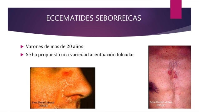 Dermatitis seborreica en axilas_2