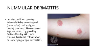 Dermatitis-Types-and-Management_Talabucon.pptx