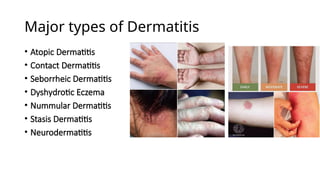 Dermatitis Classification Dermatitis-Types-and-Management_Talabucon.pptx