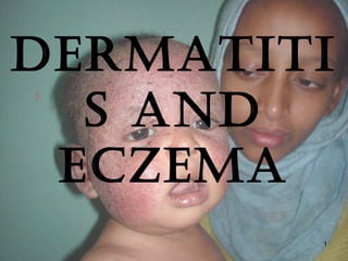 Dermatiti
s anD
eczema
1
 