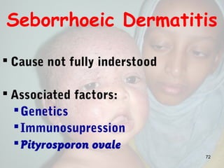 Seborrhoeic Dermatitis
 Cause not fully inderstood
 Associated factors:
Genetics
Immunosupression
Pityrosporon ovale
72
 