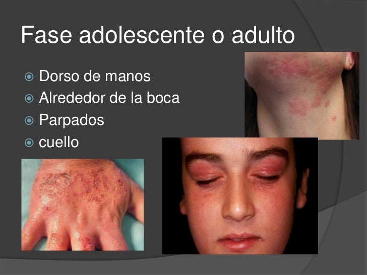 El ungüento chino de la psoriasis la instrucción