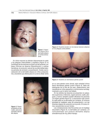 • Rev Cent Dermatol Pascua • Vol. 8, Núm. 3 • Sep-Dic 1999

172           Beirana Palencia A. Educación Médica Continua. Dermatitis atópica




                                                                           Figura 3. Paciente escolar con las típicas lesiones atópicas
                                                                           en los pliegues antecubitales.
                                                  Figura 1. Aspec-
                                                  tos clínicos de la
                                                  dermatitis atópica
                                                  en la fase del lac-
                                                  tante.


   En niños mayores se afectan clásicamente el cuello
y los pliegues antecubitales y poplíteos (Figura 3), la
morfología de las lesiones es igual a la del lactante y en
fases crónicas se observa liquenificación y costras
hemáticas; la evolución natural de la enfermedad alter-
na periodos de remisión y exacerbación. Existe una lo-
calización de la dermatitis atópica en niños preescola-
res y escolares que afecta pies en su tercio distal; tanto


                                                                           Figura 4. Paciente con dermatosis plantar juvenil.

                                                                           en su cara plantar como dorsal, esta variedad clínica
                                                                           llama dermatosis plantar juvenil (Figura 4), debe ser
                                                                           distinguida de la tiña de los pies, padecimiento casi
                                                                           inexistente en niños pequeños y comúnmente mal diag-
                                                                           nosticado y por lo tanto mal tratado.
                                                                              En los adultos las lesiones se presentan en párpa-
                                                                           dos superiores e inferiores, región perioral, cuello, plie-
                                                                           gues y manos; también pueden afectarse los pezones
                                                                           y la región genital (Figura 5). La asociación más común
                                                                           en esta edad es la dermatitis por contacto. El síntoma
                                            www.medigraphic.com            principal en cualquier edad de presentación y en las
                                                                           diversas etapas de evolución es el prurito. El curso clí-
Figura 2. Pacien-                                                          nico característico es por brotes.
te lactante con der-                                                          Las complicaciones más frecuentes son el impétigo
matitis seborreica                                                         secundario (Figura 6), la dermatitis por contacto y el
asociada a derma-                                                          corticoestropeo que produce dermatitis atópica
titis atópica.                                                             eritrodérmicas de muy difícil manejo.
 