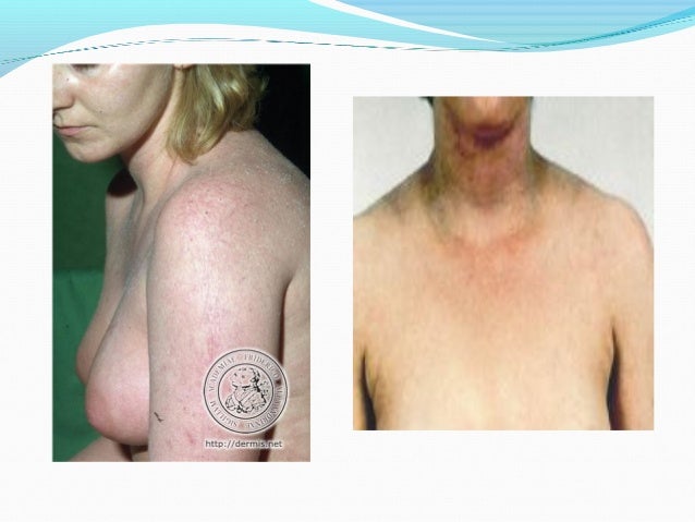 La artritis a la psoriasis el tratamiento