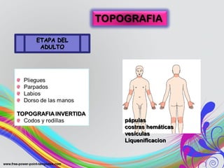 pápulaspápulas
costras hemáticascostras hemáticas
vesículasvesículas
LiquenificacionLiquenificacion
 