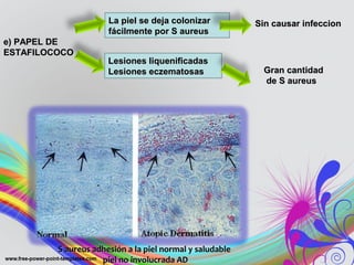 e) PAPEL DEe) PAPEL DE
ESTAFILOCOCOESTAFILOCOCO
S aureus adhesión a la piel normal y saludableS aureus adhesión a la piel normal y saludable
piel no involucrada ADpiel no involucrada AD
La piel se deja colonizarLa piel se deja colonizar
fácilmente por S aureusfácilmente por S aureus
Sin causar infeccionSin causar infeccion
Lesiones liquenificadasLesiones liquenificadas
Lesiones eczematosasLesiones eczematosas Gran cantidadGran cantidad
de S aureusde S aureus
 