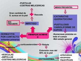 IMPETIGOIMPETIGO
DERMATITISDERMATITIS
POR CONTACTOPOR CONTACTO
-VESICULAS
-AMPOLLAS
-COSTRAS MELICERICAS
-CATARATAS-CATARATAS
-QUERATOCONO-QUERATOCONO
-PUSTULOSIS-PUSTULOSIS
VARIOLIFORME DEVARIOLIFORME DE
KAPOSIKAPOSI
MASMAS
FRECUENTEFRECUENTE
-Numerosas pústulas en-Numerosas pústulas en
todo el cuerpotodo el cuerpo
-Mal estado general-Mal estado general
MENOS FRECUENTES:MENOS FRECUENTES:
-PUSTULAS-PUSTULAS
-COSTRAS MELICERICAS-COSTRAS MELICERICAS
Gran cantidad de
S. aureus en la piel Rascado
Irritantes primarios
Tx indebidos
corticoesteroides Rebote
Extensión mas del
80% de la piel
-eritematosa
-escamosa
-liquenificadaERITRODERMIA
COMPLICACIONECOMPLICACIONE
SS
 