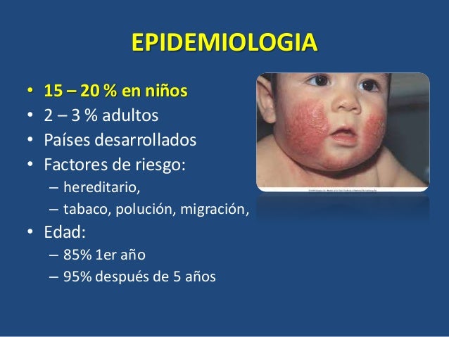 El tratamiento de la eccema a los niños sobre un año