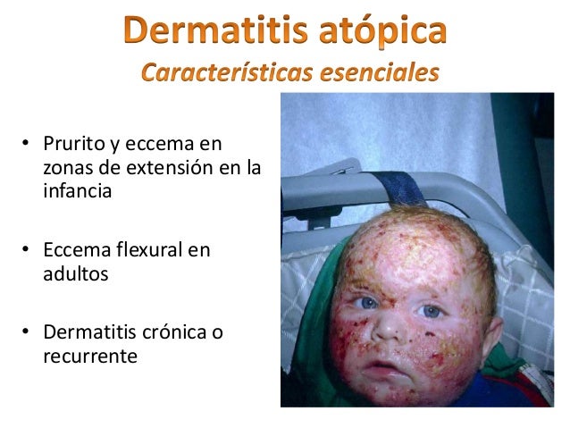 Como aceptar deksametazon en las pastillas a la psoriasis
