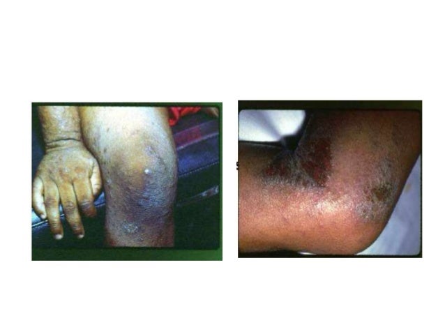 La psoriasis como el medio mejor al tratamiento