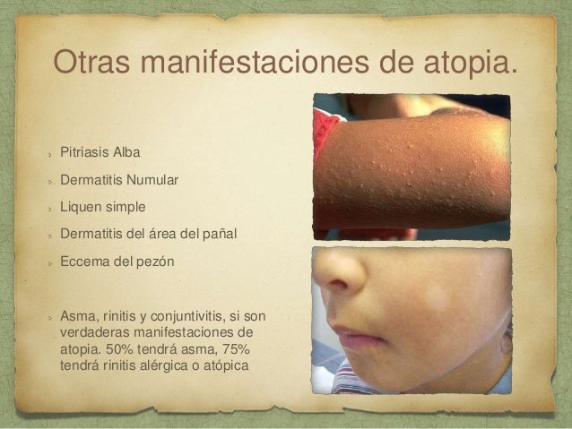 La psoriasis el tratamiento 4 años