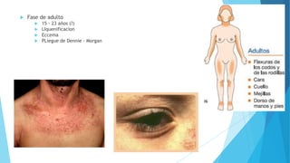  Fase de adulto
 15 - 23 años (?)
 LIquenificacion
 Eccema
 PLiegue de Dennie - Morgan
 