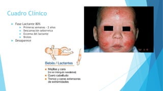 Cuadro Clínico
 Fase Lactante 80%
 Primeras semanas - 2 años
 Descamación seborreica
 Eccema del lactante
 Brotes
 Desaparece
 